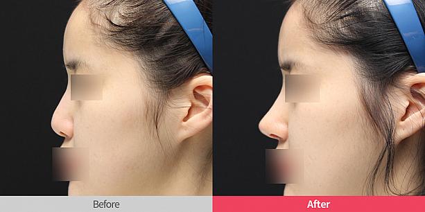 【ＰＲ】リスタ整形外科で相談！鼻手術、鼻の構造、形を考慮して行われるべき。美容外科クリニック