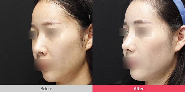 【ＰＲ】リスタ整形外科での鼻整形シリコンや挿入物は何を使う？美容外科クリニック