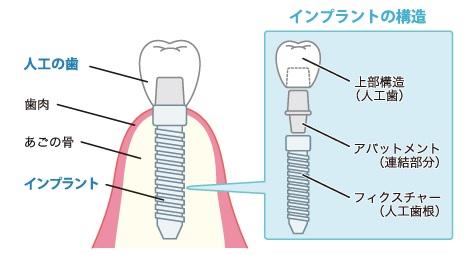 【ＰＲ】もし歯を失ったらどうしますか？インプラントで解決！！