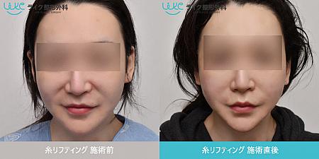 【ＰＲ】ライク整形外科が提案する「長い顔から短い顔」への改善 美容外科クリニック メディカル美容江南駅