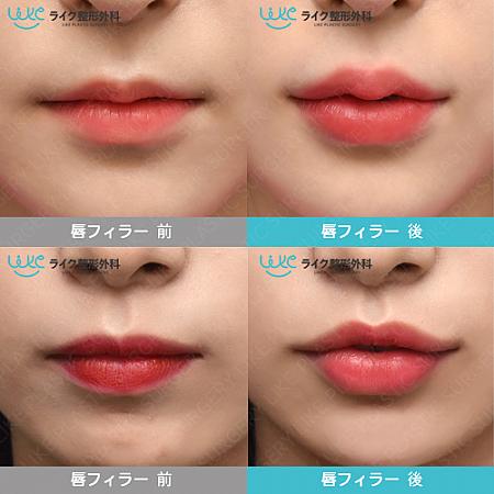 【PR】ライク整形外科の唇整形！自分に合った唇整形の方法は何？美容外科クリニック