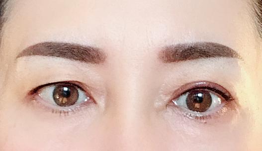 翌日
眉、アイライン上
ほんの少し腫れ
全く痛くない