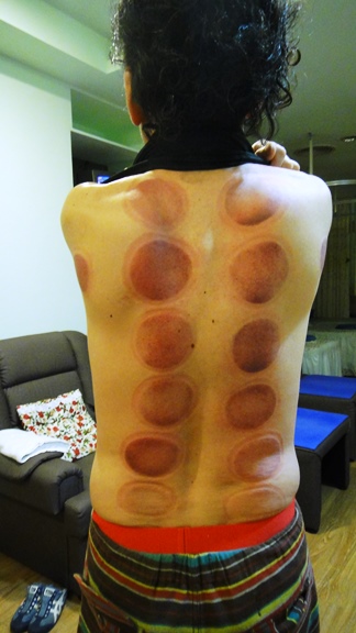 カッピング直後の惨状（笑）