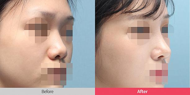 【PR】ソウルリスタ整形外科を詳しく見てみよう！ 整形 鼻整形 美鼻 だんご鼻 わし鼻美容外科クリニック