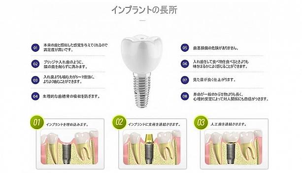 【PR】韓国でインプラントは一般的！インプラントについて詳しくご紹介！！ インプラント 韓国 美容 審美歯科 韓国のインプラント 審美歯科クリニックインプラント治療