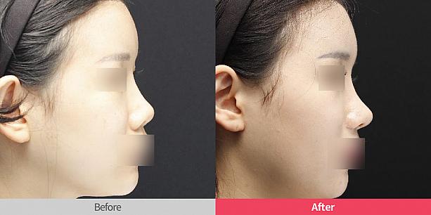 【PR】リスタ整形外科で相談！鼻の再手術について！ 鼻整形 韓国美容整形外科 ソウル美容整形外科 鼻の再手術 鼻整形炎症 副作用 鼻整形失敗 鼻シリコン美容外科クリニック