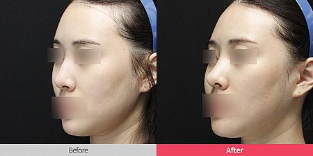 【ＰＲ】リスタ整形外科で相談！鼻の再手術で重要なのは何を挿入するか？
