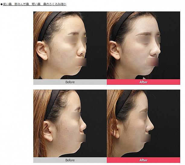 【ＰＲ】顔に合った鼻整形の重要性 美容外科クリニック 江南駅 江南 鼻 韓国 整形#韓国鼻整形