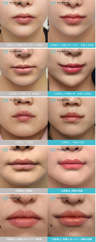 フィラー 口角 唇フィラーの症例です【TAクリニック公式整形ブログ】画像･値段｜美容整形･美容外科