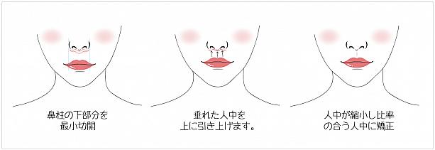 【ＰＲ】ライク整形外科で笑顔を手に入れる！唇整形 美容外科クリニック江南駅