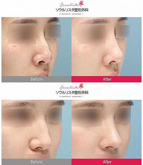 【ＰＲ】無シリコン鼻整形とは？ 江南駅 美容外科クリニック 鼻整形 韓国整形美容外科