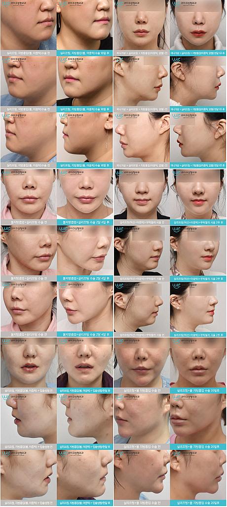 【PR】顔の脂肪吸引と糸リフティングは一緒にするべきなの？（ライク整形外科）美容外科クリニック