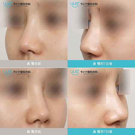 【ＰＲ】鼻の手術方法で考えなければいけないことは？（ライク整形外科）美容外科クリニック