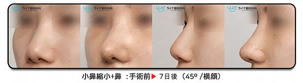 【PR】ライク整形外科の提案する私に似合う鼻の形と高さはどのぐらいだろう？美容外科クリニック