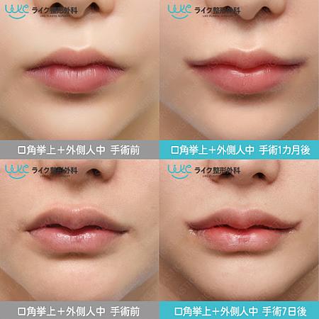 【PR】ライク整形外科の唇整形！自分に合った唇整形の方法は何？美容外科クリニック