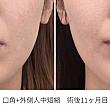 口角＋外側人中短縮　術後11か月目