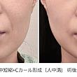 内側人中短縮＋Cカール形成（人中溝）　術後5か月目