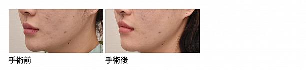 【PR】ライク整形外科の人中の溝をCカールに！ ソウル美容整形 人中 美容外科美容整形