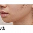 【PR】ライク整形外科の人中の溝をCカールに！ ソウル美容整形 人中 美容外科美容整形