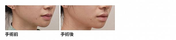【PR】ライク整形外科の人中の溝をCカールに！ ソウル美容整形 人中 美容外科美容整形