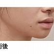 【PR】ライク整形外科の人中の溝をCカールに！ ソウル美容整形 人中 美容外科美容整形