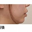 【PR】ライク整形外科の人中の溝をCカールに！ ソウル美容整形 人中 美容外科美容整形