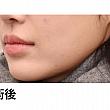 【PR】ライク整形外科の人中の溝をCカールに！ ソウル美容整形 人中 美容外科美容整形