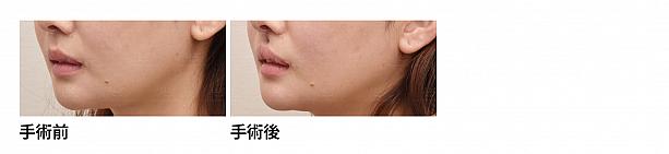 【PR】ライク整形外科の人中の溝をCカールに！ ソウル美容整形 人中 美容外科美容整形