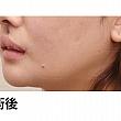 【PR】ライク整形外科の人中の溝をCカールに！ ソウル美容整形 人中 美容外科美容整形