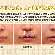 【PR】ライク整形外科のたらこ唇改善方法！！ ソウル美容整形 皮膚科 韓国美容 唇短縮