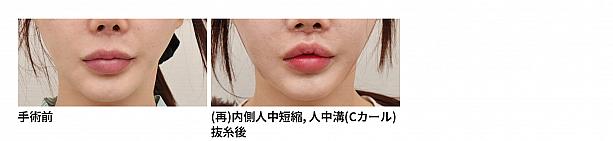 【PR】ライク整形外科の人中口角再手術！！ ソウル美容整形口元