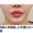 【PR】ライク整形外科の人中口角再手術！！ ソウル美容整形口元