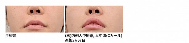 【PR】ライク整形外科の人中口角再手術！！ ソウル美容整形口元