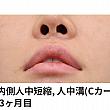 【PR】ライク整形外科の人中口角再手術！！ ソウル美容整形口元