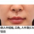 【PR】童顔整形といえば、ライク整形外科の中顔面短縮！！ ソウル美容整形 人中 ソウル皮膚科 アンチエイジング 韓国美容 中央部短縮 中顔面リフトアップ