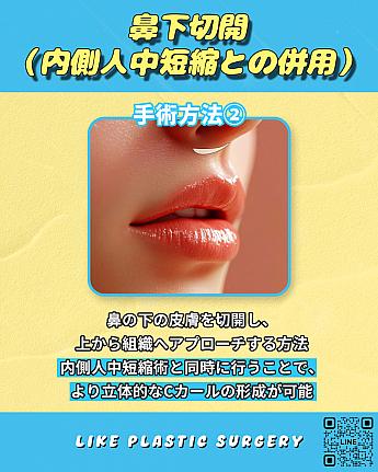 【PR】Cカール形成、どちらの切開法がベスト？！ ソウル美容整形 整形 美容 口元アンチエイジング