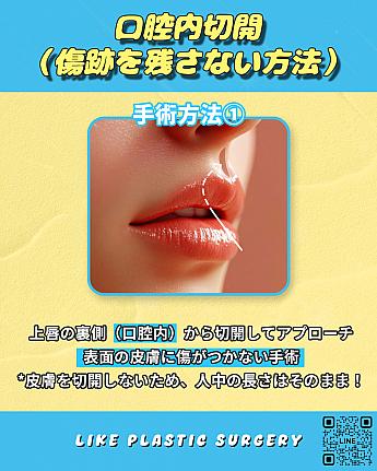 【PR】Cカール形成、どちらの切開法がベスト？！ ソウル美容整形 整形 美容 口元アンチエイジング