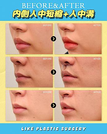 【PR】Cカール形成、どちらの切開法がベスト？！ ソウル美容整形 整形 美容 口元アンチエイジング