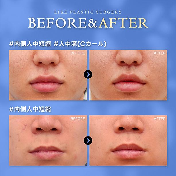 【PR】知ってました？男性も口元整形で、魅力アップ！！！ソウル美容整形