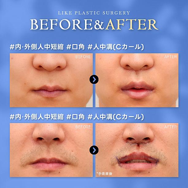 【PR】知ってました？男性も口元整形で、魅力アップ！！！ソウル美容整形
